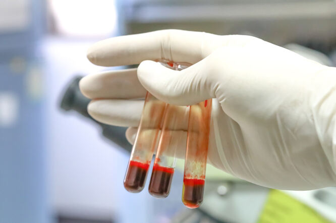 Novi test krvi može otkriti preeklampsiju u prvom tromjesečju trudnoće