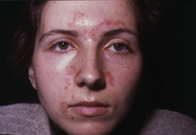 Dermatitis Seborrhoica