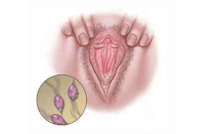 trihomonas-vaginalis-1a