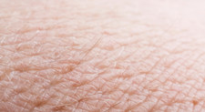 Koji su uzroci seboroičnog dermatitisa i kako se liječi?