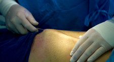 Liposukcija