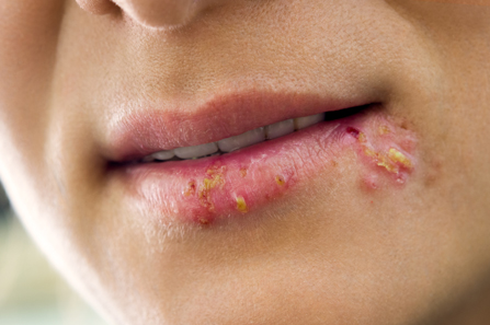 Aciklovir – pomoć protiv ponavljajuće infekcije oralnim herpesom