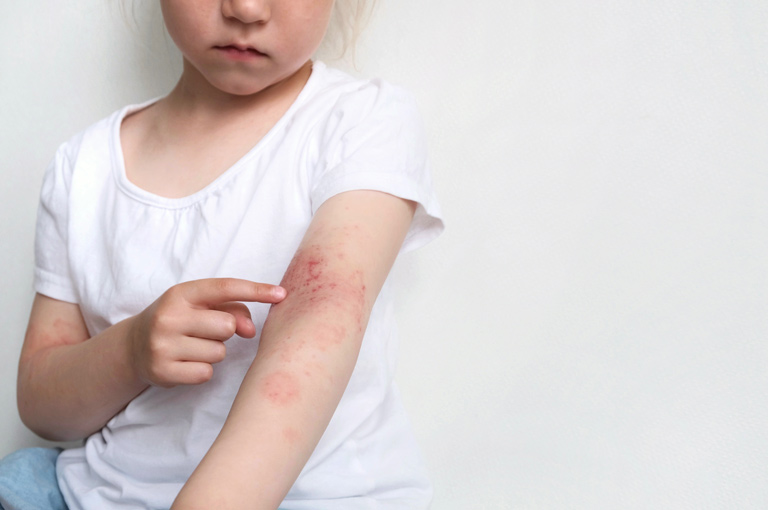 Djeca s ekcemom imaju veću vjerojatnost da će imati alergijski kontaktni dermatitis