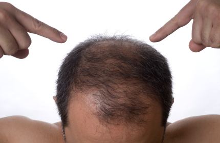 Geni povezani s poremećajem gubitka kose