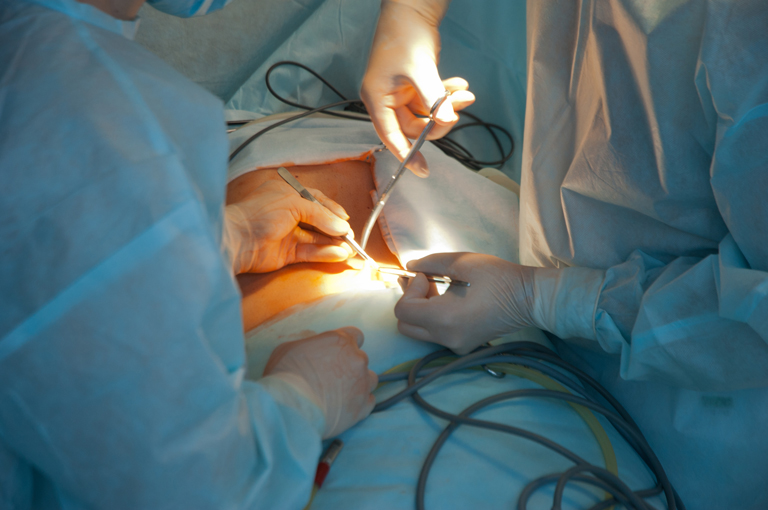 Kolecistektomija povezana s manjim rizikom od moždanog udara u pacijenata s žučnim kamencima
