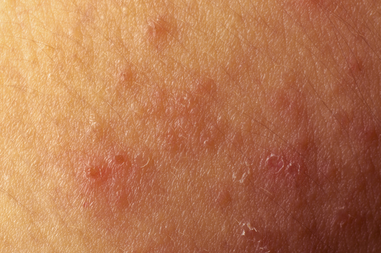 Prekretnica u liječenju atopijskog dermatitisa