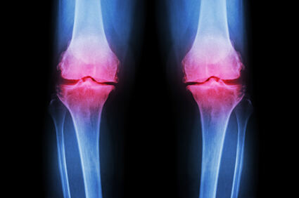 Snižavanje tjelesne težine smanjuje degeneraciju hrskavice koljena