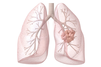 Terapija zračenjem pomaže pacijentima s uznapredovalim rakom pluća