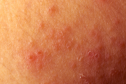 Simptomi atopijskog dermatitisa 