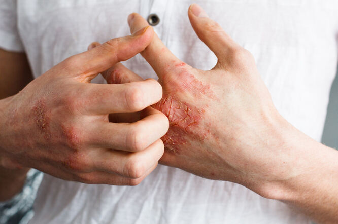 Što je atopijski dermatitis?