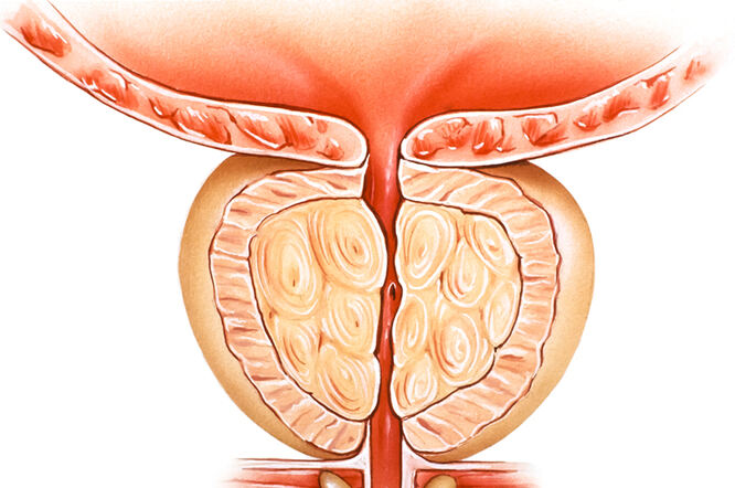 upala prostate i plodnost a bokaízület ízületi gyulladásának okai