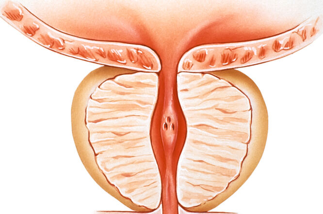 adenom de prostata semne si simptome