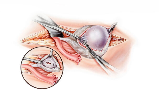 Liječenje ciste na jajnicima
