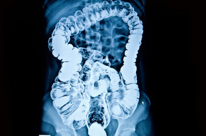 Dijagnosticiranje Crohnove bolesti