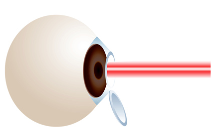 Laserska korekcija dioptrije i ugradnja leća za velike dioptrije