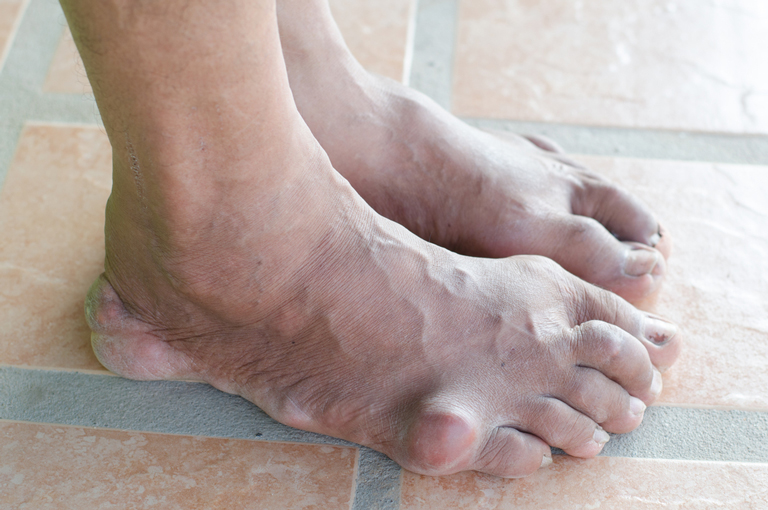 simptomi i liječenje gihta stopala