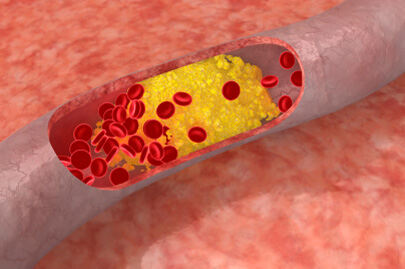 crvene točke u hipertenzije kontrola hipertenzija