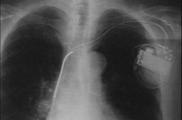 Što je implantabilni kardioverter-defibrilator (ICD)?