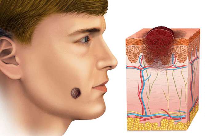 Znakovi i simptomi melanoma