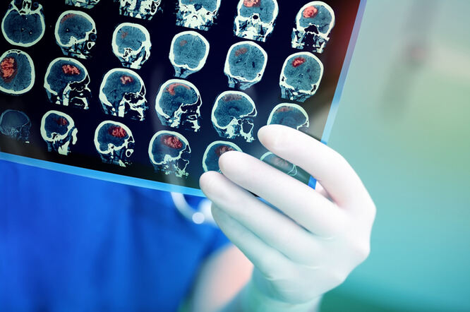 Dijagnosticiranje moždanog udara