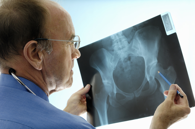 Što je osteoporoza?
