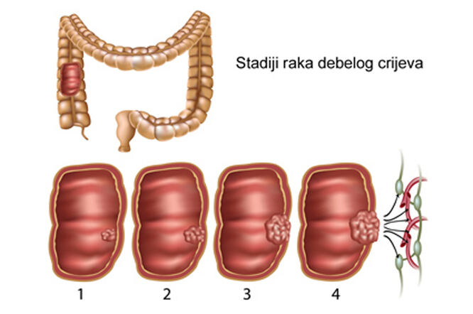 Stadiji razvoja raka debelog crijeva