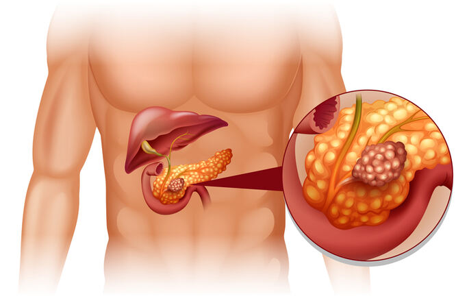Rak gušterače - osnovne karakteristike bolesti
