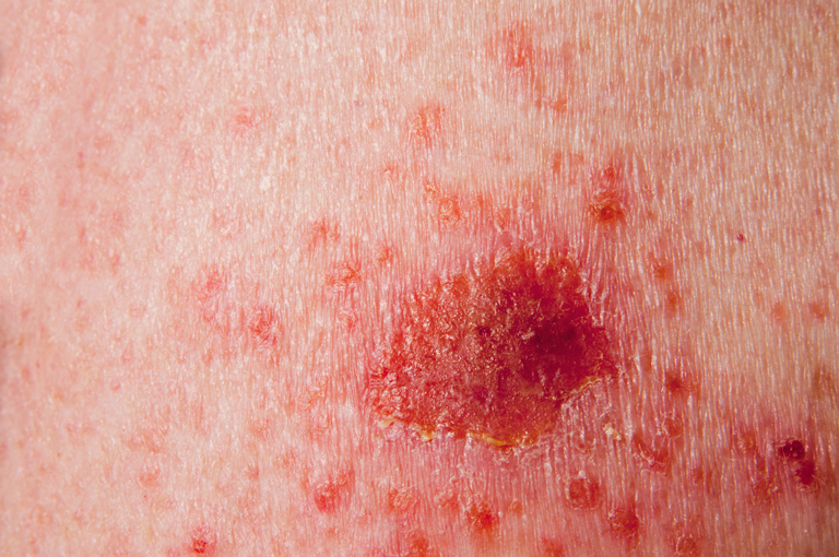 Što je rak kože?