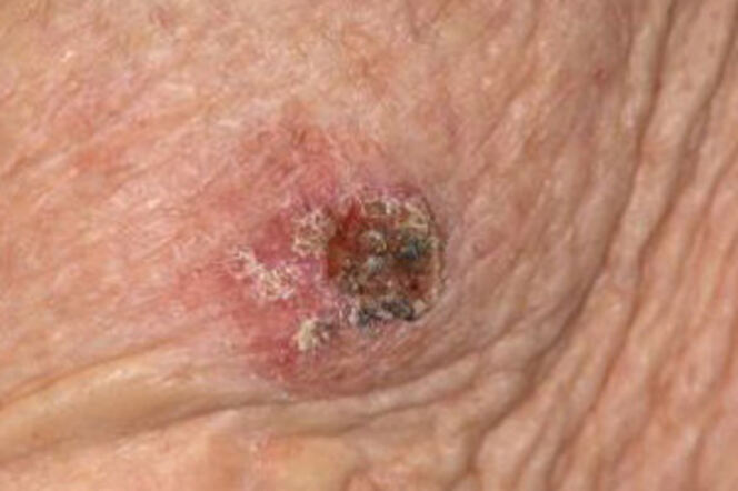 Znakovi i simptomi raka kože