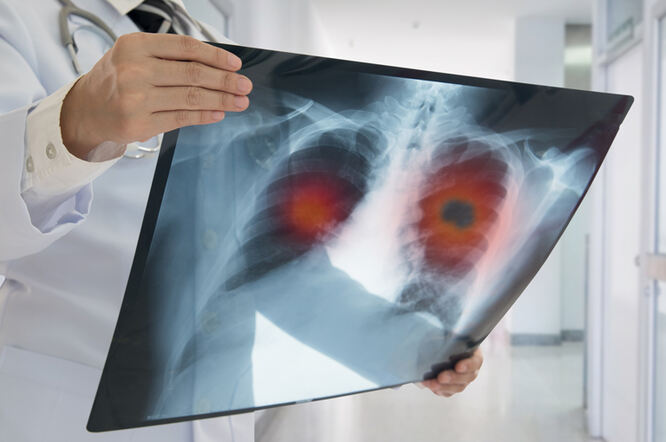 Krvna slika kod raka pluća