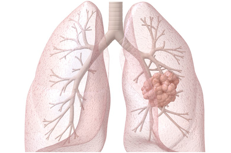 Što je rak pluća?