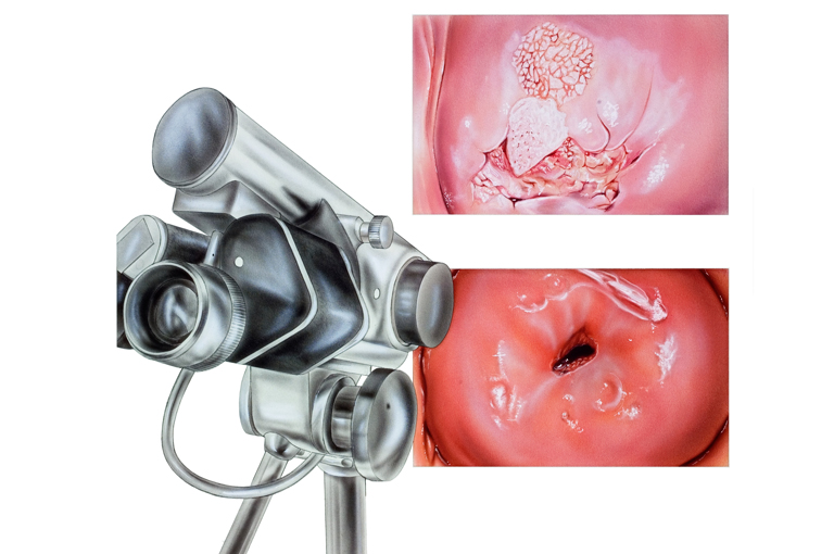 Što su kolposkopija i biopsija?