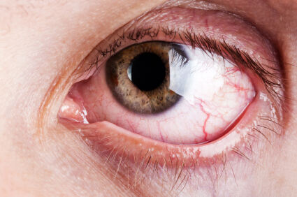 Što je sindrom suhog oka?