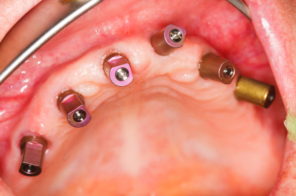 zubni implantati i hipertenzije