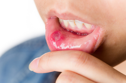 Najčešći simptomi i bolesti oralne sluznice - kako ih prepoznati i liječiti?