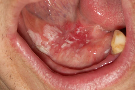 Oralni karcinom i uloga stomatološke struke u njegovom ranom otkrivanju