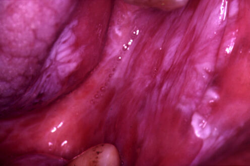Oralni lihen ruber