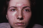 Seboroični dermatitis