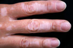 Vitiligo