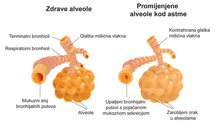 alveole-astma-1b