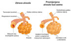 alveole-astma-1b