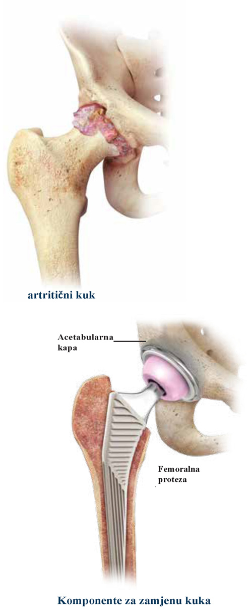 Femoralna osteoplastika - Uklanjanje kostiju iz kosti