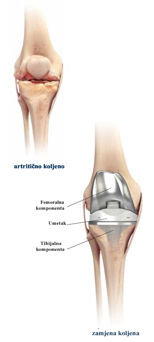 artritično-koljeno-1ndn2