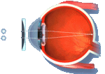 Astigmatizam1