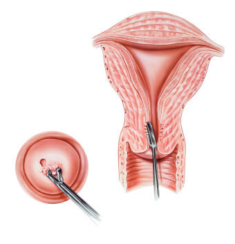 biopsija vrata maternice