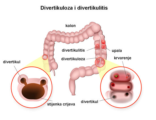 divertikuloza-3b