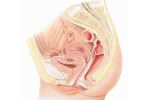 endometrioza3