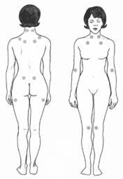 fibromialgija