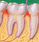 gingivitis