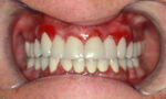 gingivitis1